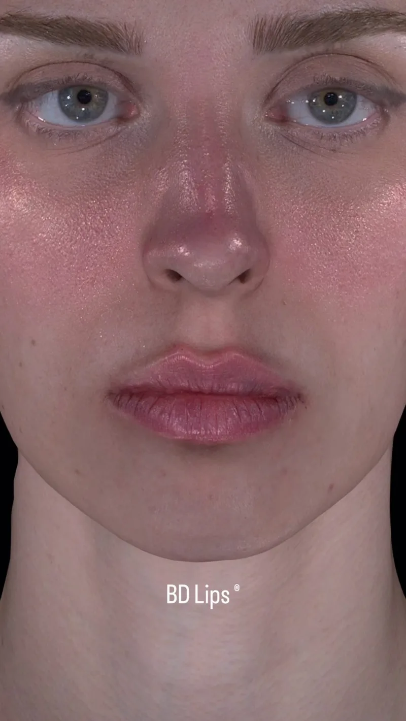 BD Lips® — göz kararı değil, Aura 3D analizi